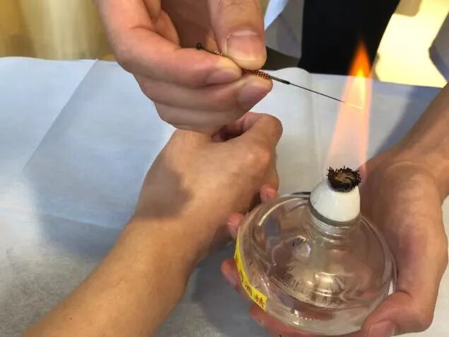 刺络拔罐